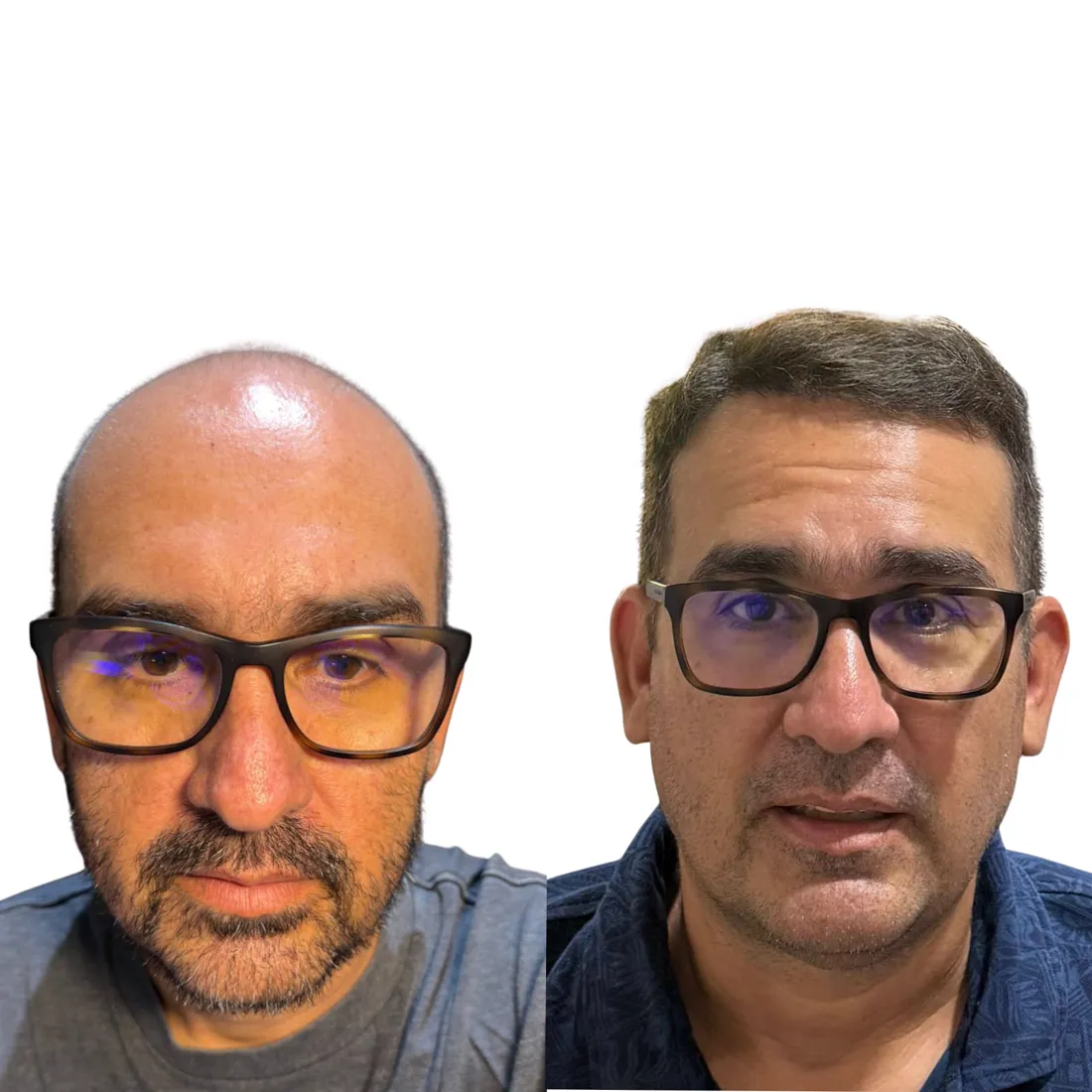 Resultado real de paciente · trasplante capilar